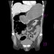 Ulcerative colitis of left colon, enterography: CT - Computed tomography